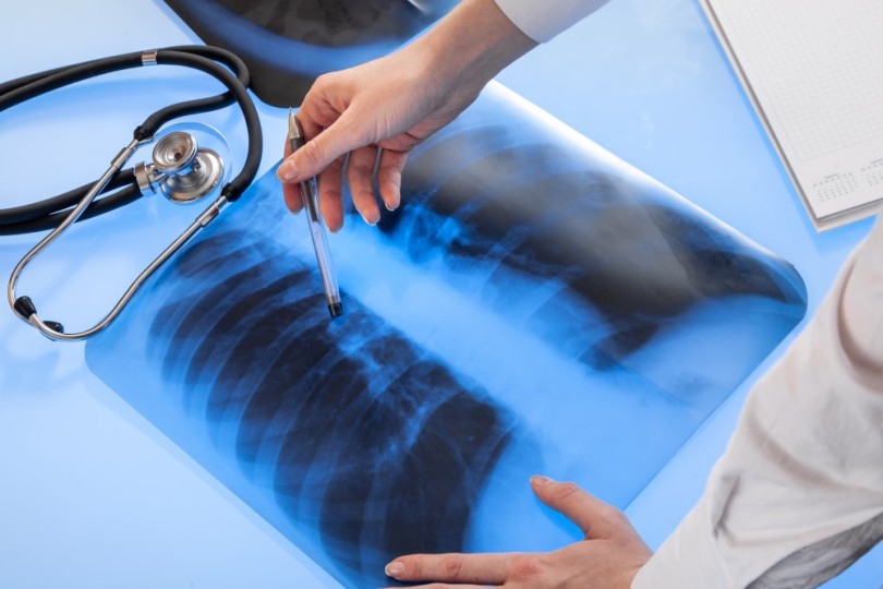 Lung Scan Lung Scan